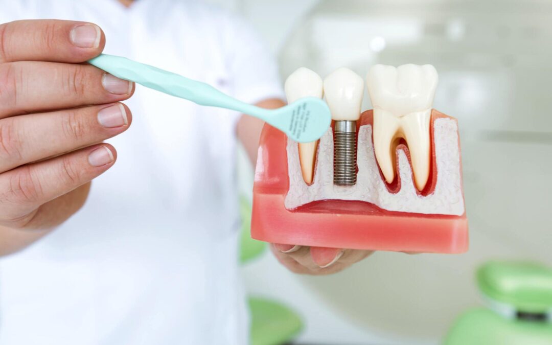 Qu’est-ce qu’un implant dentaire ?