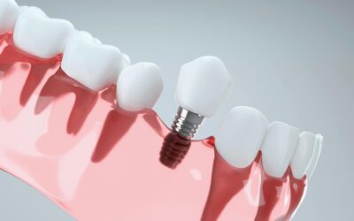 Implant dentaire à Paris 16