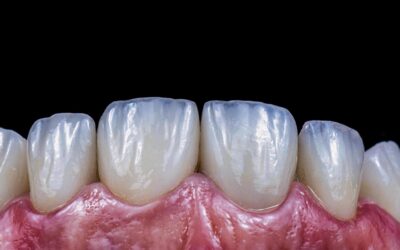 Des facettes céramique pour corriger la surface des dents