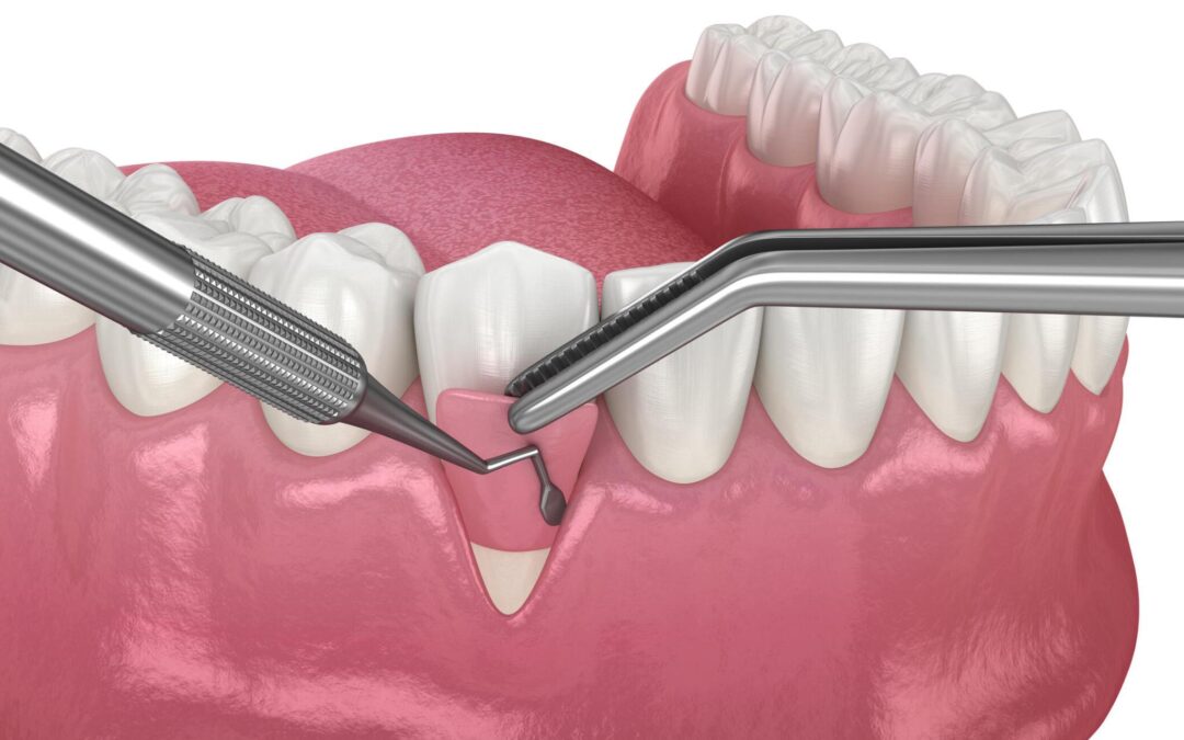 La greffe gingivale