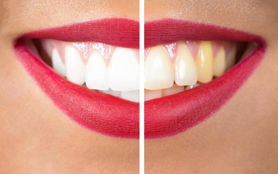 Facette dentaire : Transformation de dents jaunes et colorées