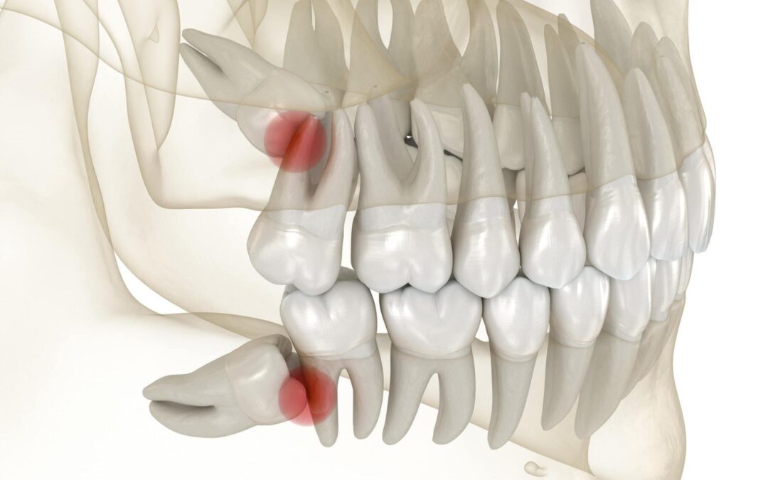 Les dents de sagesse