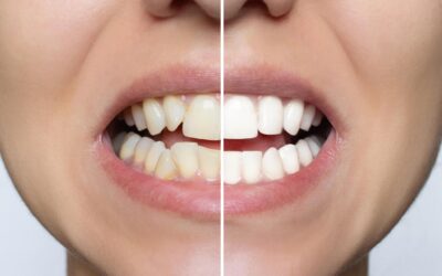 Correction d’espace dentaire par facette et modification de la forme des dents