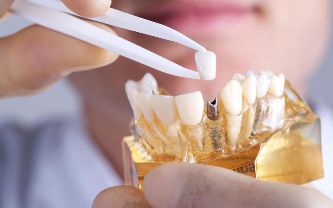 Pose d’implants dentaires