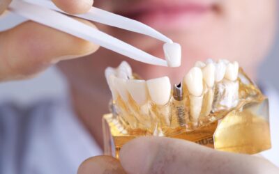 Pose d’implants dentaires