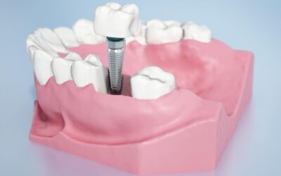 Prothèse dentaire sur implant